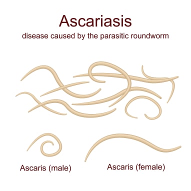 Ascariasis